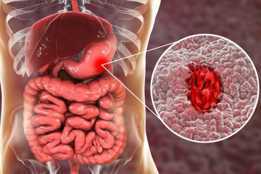 dealing with peptic ulcers